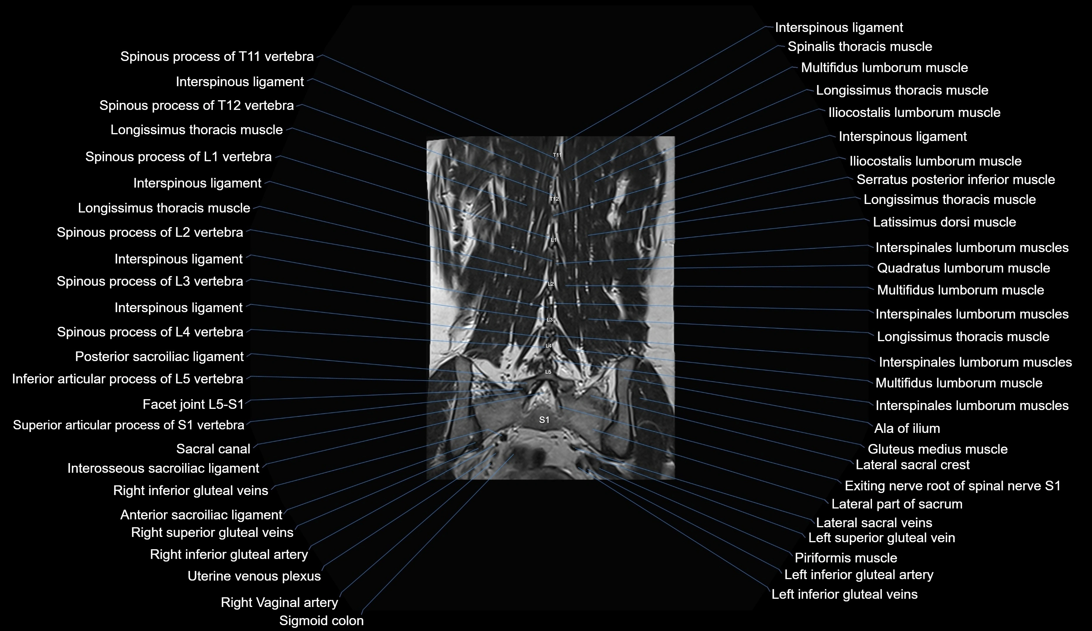 MRI lumbar spine coronal cross sectional anatomy 3T radiology  image-img-00001-00027.webp